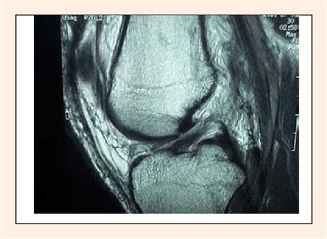 Mri Scan Of Ruptured Acl In Case 4 Case 4 Diagnosis Right Knee