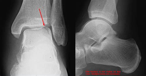 Osteochondral Fracture Of The Talar Dome