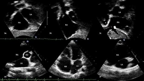 Panels 3a 3b And 3c Are 2d Transthoracic Echocardiographic Images From