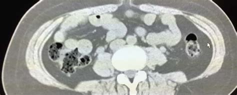 Umbilical Hernia On Ct Radiology In Plain English