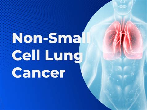 Non Small Cell Lung Cancer Nsclc Causes Symptoms And Treatment
