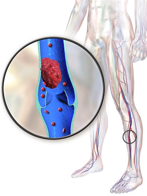 This results in a slowing down of the vital functions, and can cause death. Best Methods For How To Treat Deep Vein Thrombosis