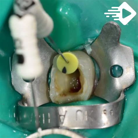 Tratamento endodôntico manual e mecanizado Academia da Odontologia