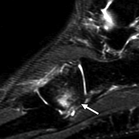 Mri Of Isolated Cuboid Stress Fractures In Adults Ajr