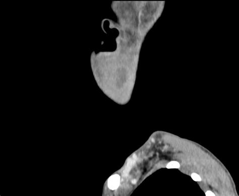 Subcutaneous Neck Abscess Image