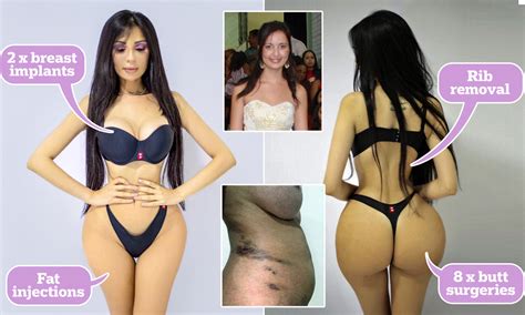 Rib Removal Surgery Before And After Pictures Picturemeta