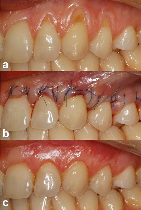 A Pre Operative View Of Gingival Recessions On Control Side B