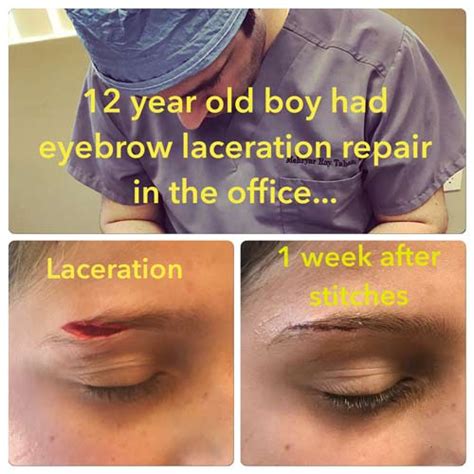 Eyelid Laceration Surgery By Beverly Hills Plastic Surgeon