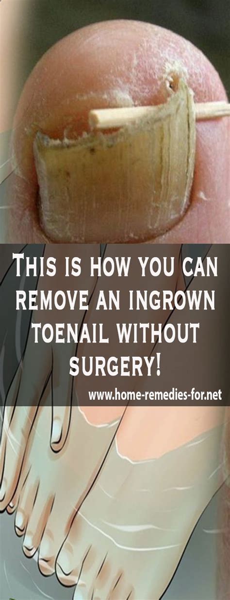 How To Fix Ingrown Toenail Without Surgery Review At How To