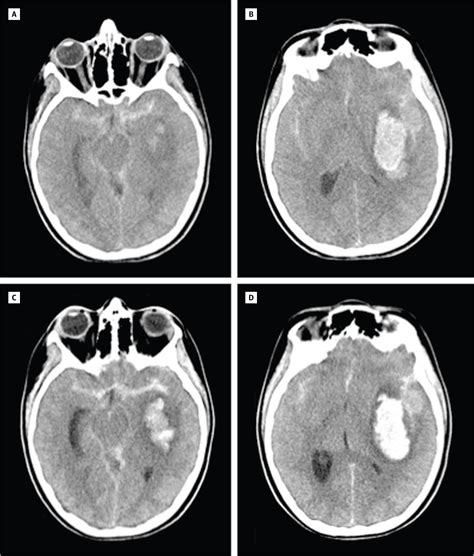 Frequency Of Hematoma Expansion After Spontaneous Intracerebral