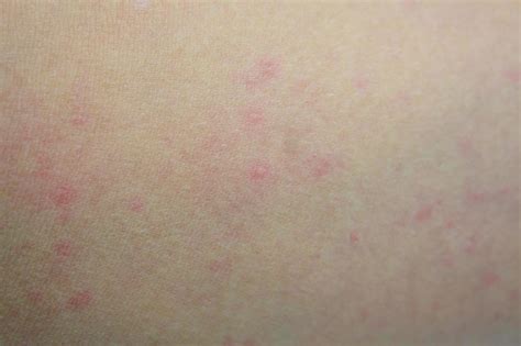 Malade éruption Cutanée Allergique Dermatite Eczéma Peau Du Patient