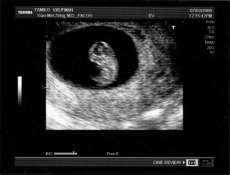 8ª Semana Del Embarazo Pequelia