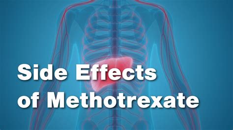 Side Effects Of Methotrexate • Johns Hopkins Rheumatology