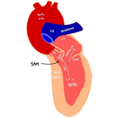 Systolic Anterior Motion Sam Of The Mitral Valve Left Ventricular