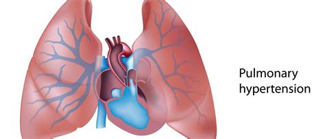 What Is Pulmonary Hypertension Pb Cardiovascular