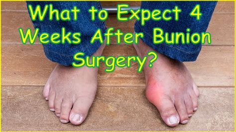 What To Expect 4 Weeks After Bunion Surgery