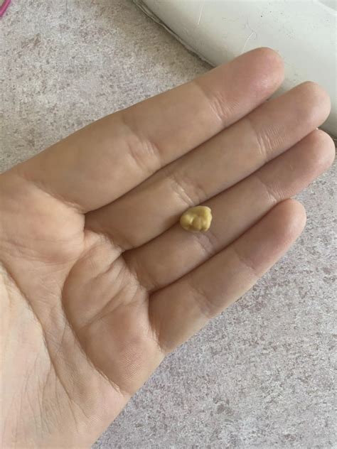 Tonsil Stone Removed Nudes By Cominella