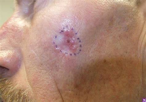 Basal Cell Carcinoma Pictures Basal Cell Carcinoma Tip Of My Xxx Hot Girl