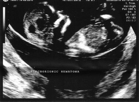 1 Two Dimensional Ultrasonography Scan Of A Subchorionic Hematoma In A