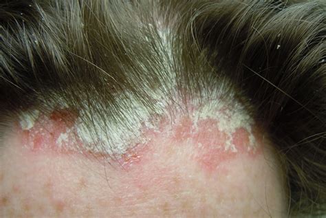 Best Scalp Psoriasis Shampoo And Treatment 2018 Reviews And Guide