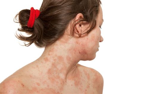Guidelines Developed For Managing Severe Atopic Dermatitis Clinical