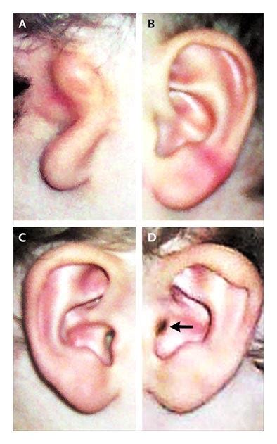 A Classic Twin Study Of External Ear Malformations Including Microtia