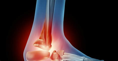 Best Ways To Relieve Arthritis Foot Pain Alternative Drugs