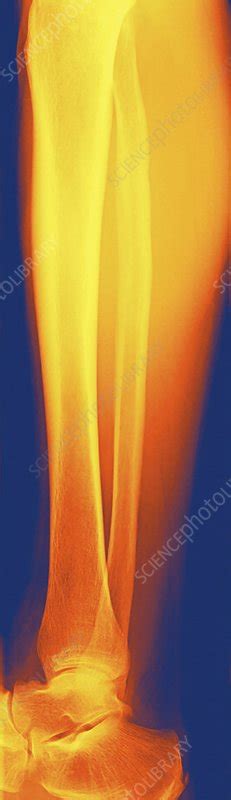 Normal Lower Leg X Ray Stock Image F0013012 Science Photo Library