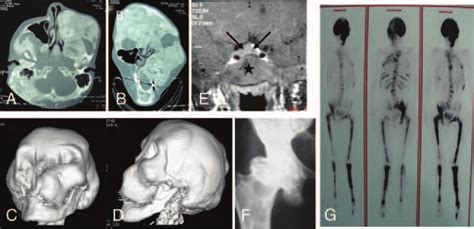 Imaging And Radiographic Aspects Of Polyostotic Fibrous Dysplasia