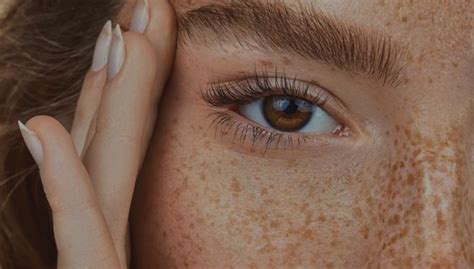 Freckles Sunspots And Moles What You Need To Know