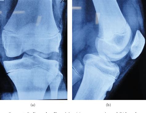 Figure From Osteochondral Fracture Lateral Femoral Condyle Treated With ORIF Using Z Plasty A