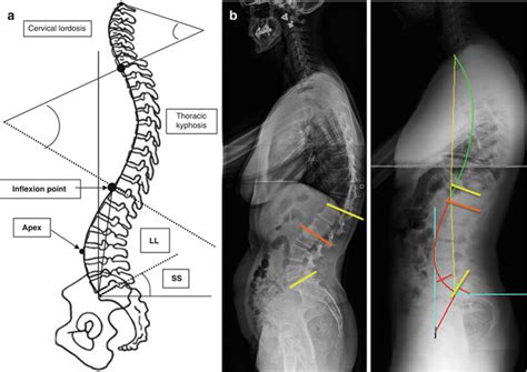 The Importance Of Sagittal Balance For The Treatment Of Lumbar
