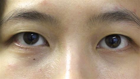 Double Eyelid Surgery Uk Asian Blepharoplasty Mr David Cheung