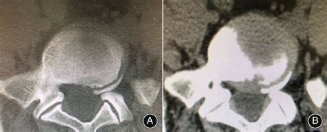 Preoperative Computed Tomography Ct Showing Lumbar Disc Protrusion