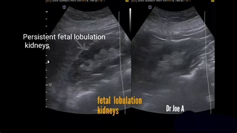 Persistent Fetal Lobulation Kidney Ultrasound Video Youtube
