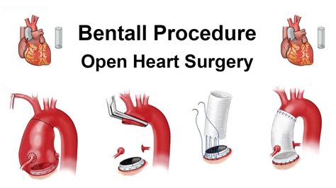 俠醫 楊智鈞醫師部落格 當班特式手術（bentall Procedure 碰上a型主動脈剝離 （type A Aortic Dissection