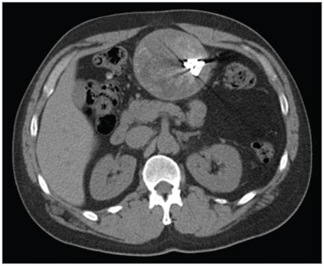 A Patient With Abnormal Abdominal Ct Scan Findings Surgery Jama