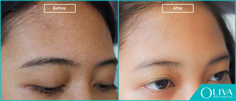 Small Pimples On Forehead Causes Best Treatments And Results