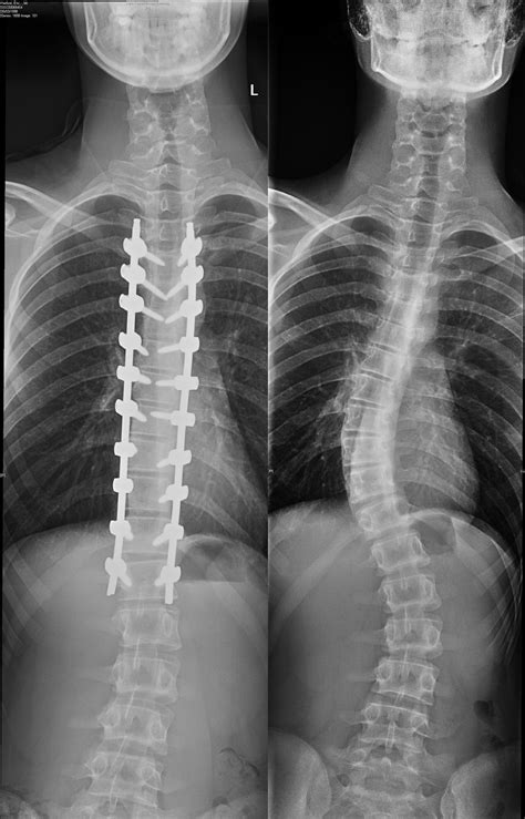 Scoliosis Surgery Before And After X Rays Pics