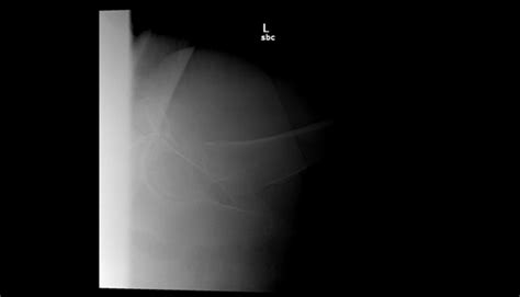 Ortho Dx Valgus Impacted Femoral Neck Fracture Clinical Advisor