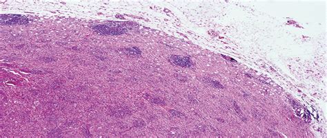 Subcutaneous Atypical Fibrous Histiocytoma The American Journal Of