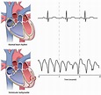 Ventricular tachycardia causes, symptoms, diagnosis, prognosis & treatment