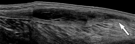 Sonography Of Bakers Cyst Popliteal Cyst The Typical And Atypical