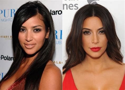 Kim Kardashian Before And After Plastic Surgery 2022