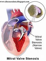 Aortic Stenosis Treatment Options Images