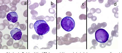Figure 17 From Plasma Cell Morphology In Multiple Myeloma And Related