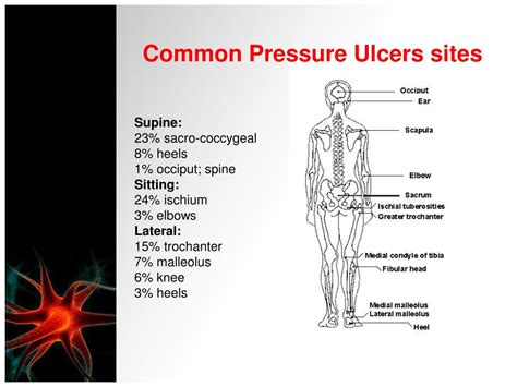 Ppt Pressure Ulcers Assessment And Management Powerpoint Presentation