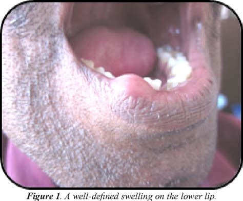 Figure 1 From A Verruciform Xanthoma Of The Lower Lip And Review Of The