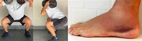 What I Learned Treating My Own Ankle Sprain