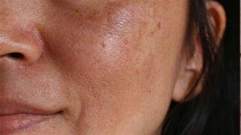 What Is Melasma And How Can You Treat It Womans World